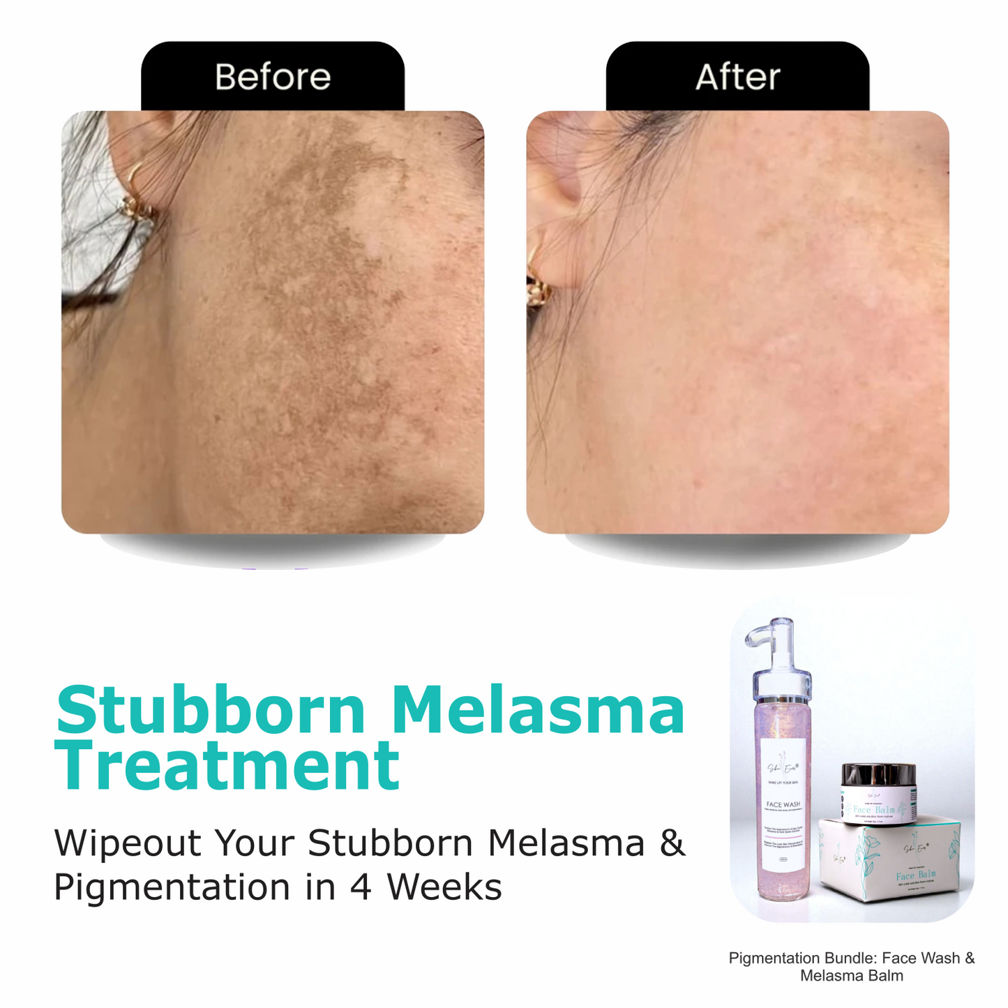 Pigmentation Bundle: Face Wash & Melasma Balm