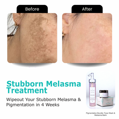 Pigmentation Bundle: Face Wash & Melasma Balm