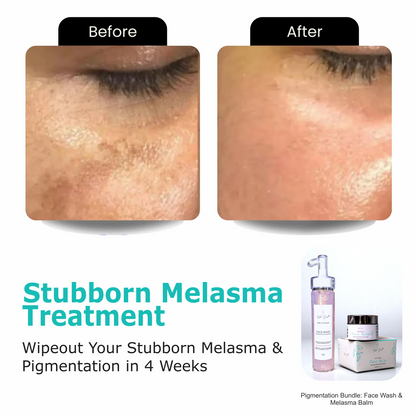 Pigmentation Bundle: Face Wash & Melasma Balm